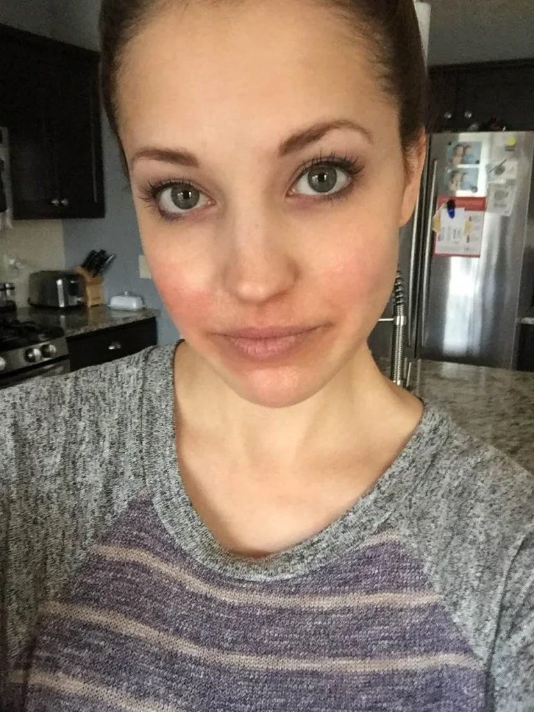 My Perioral Dermatitis Laurenda Marie